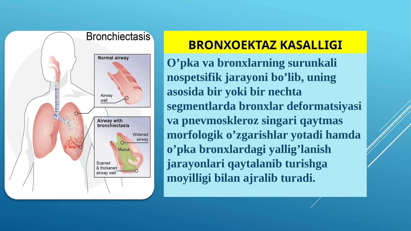 Bronxoektaz kasalligi