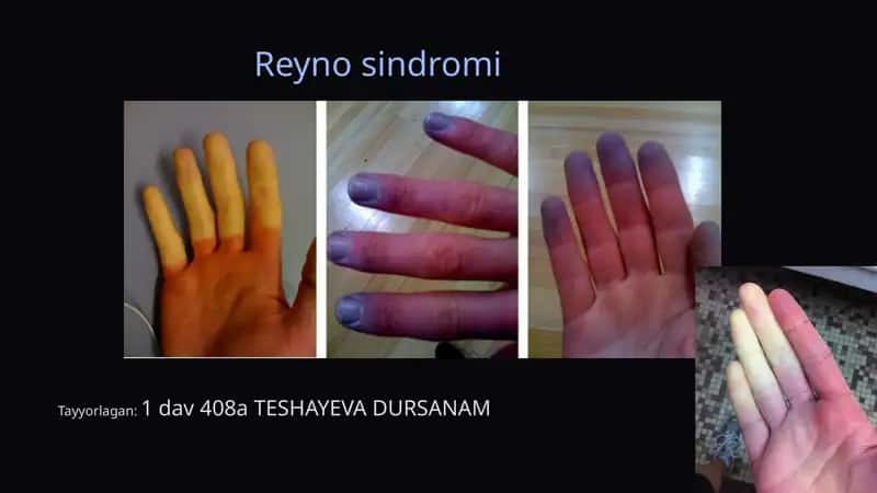 Reyno sindromi