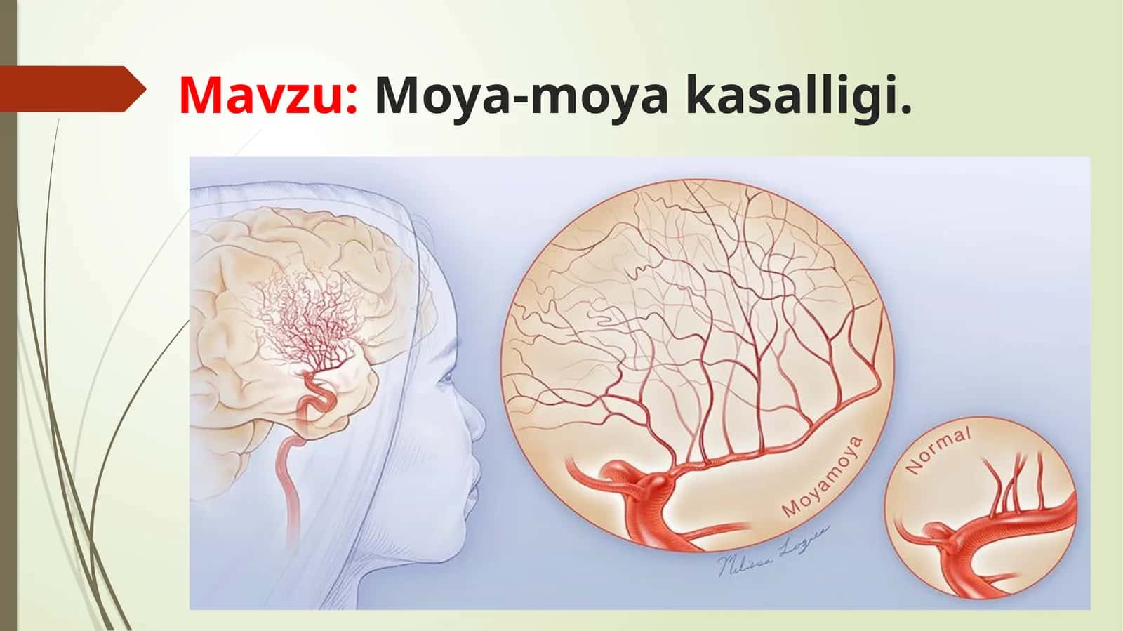 Moya-moyakasalligi