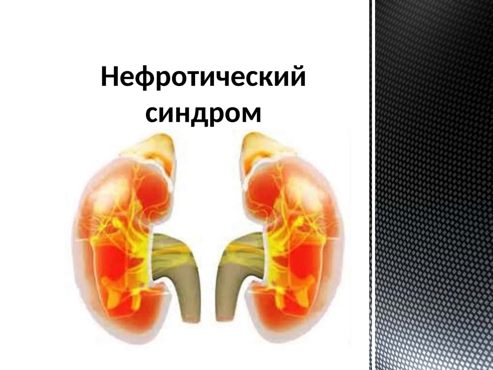 Нефротический синдром