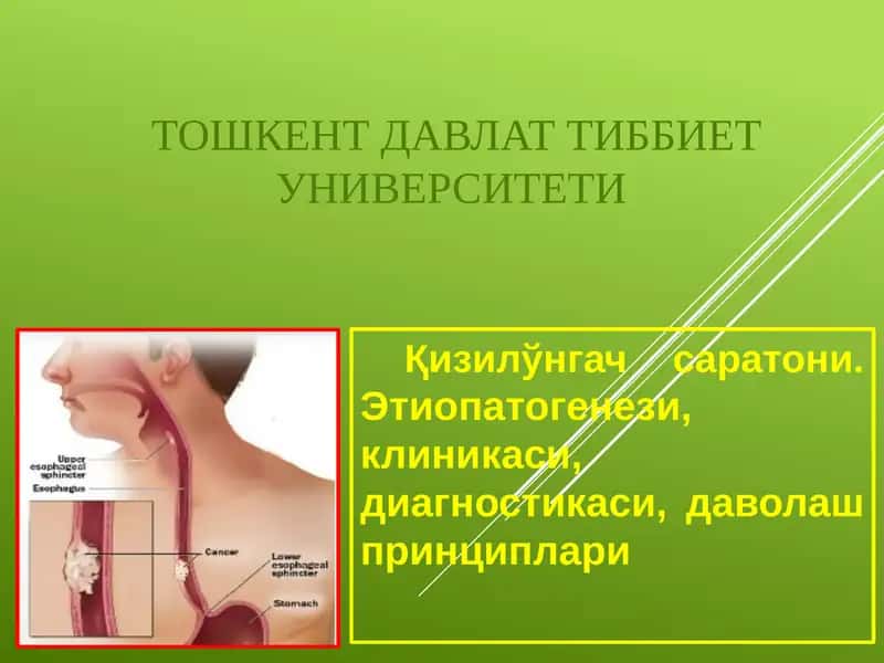 Қизилўнгач саратони.Этиопатогенези, клиникаси, диагностикаси, даволаш принциплари